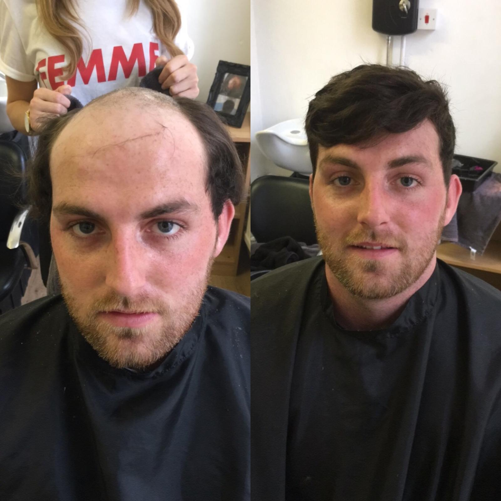 Real HLC client: thinning hair before on the left and a fuller dark side-part style on the right